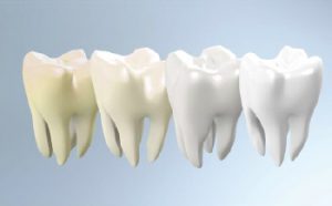 Blanqueamiento Dental en las Rozas